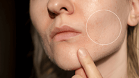 Dehydrated skin